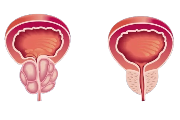 Ilustração da próstata antes e depois do uso do Bobra+
